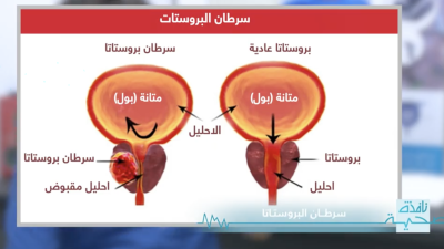 أسباب سرطان البروستاتا - Nafida Sihiya